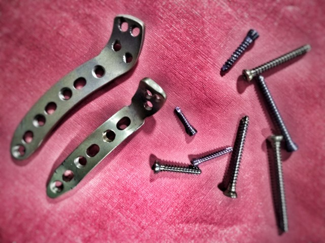 placas e parafusos.jpeg